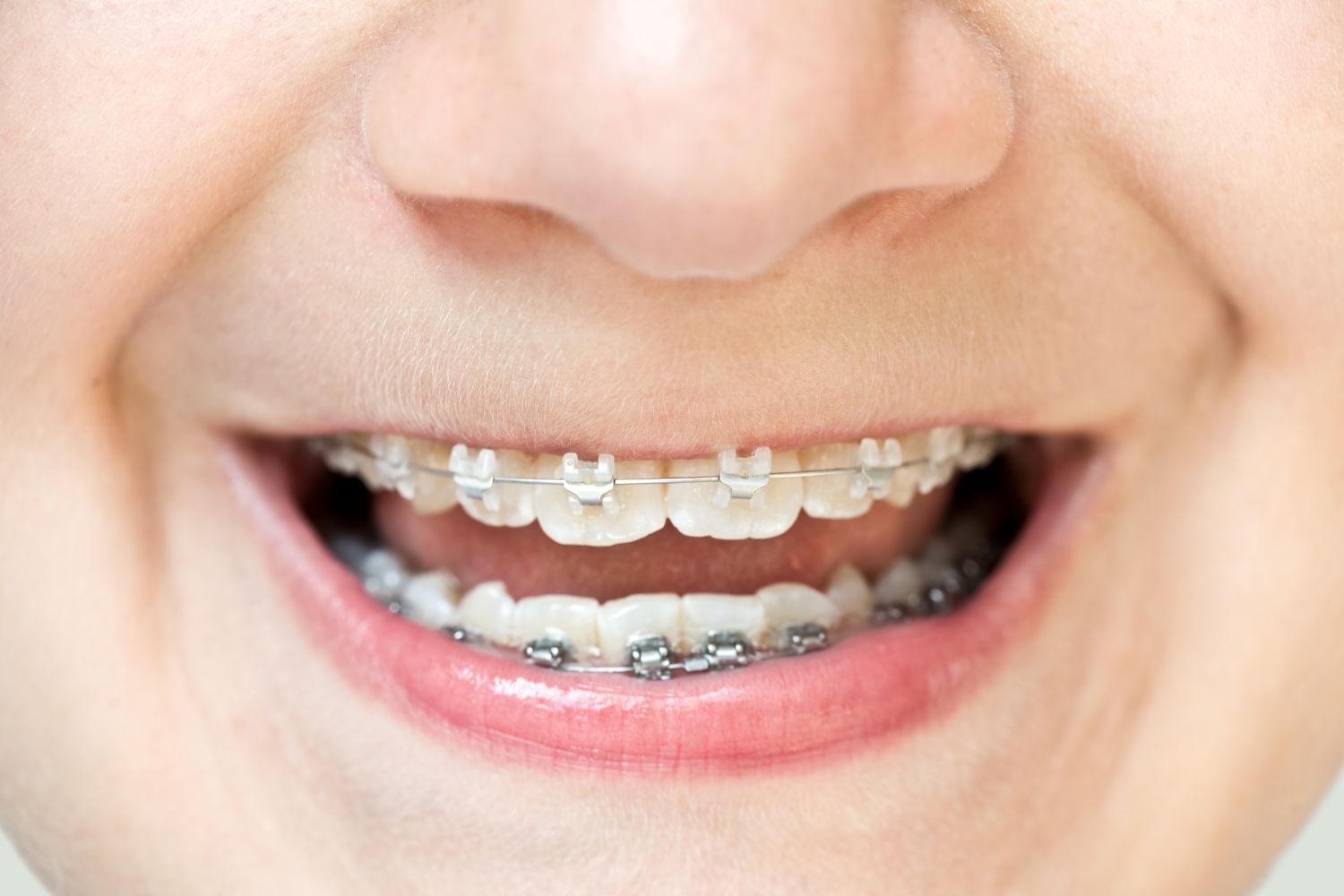 orthodontie-enfant-traitement