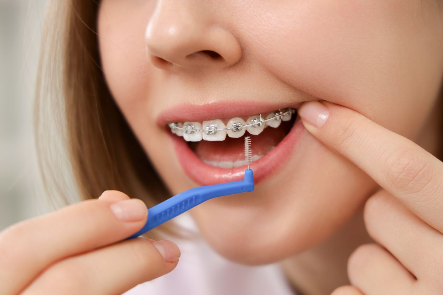 prendre soin des dents pendant un traitement orthodontique